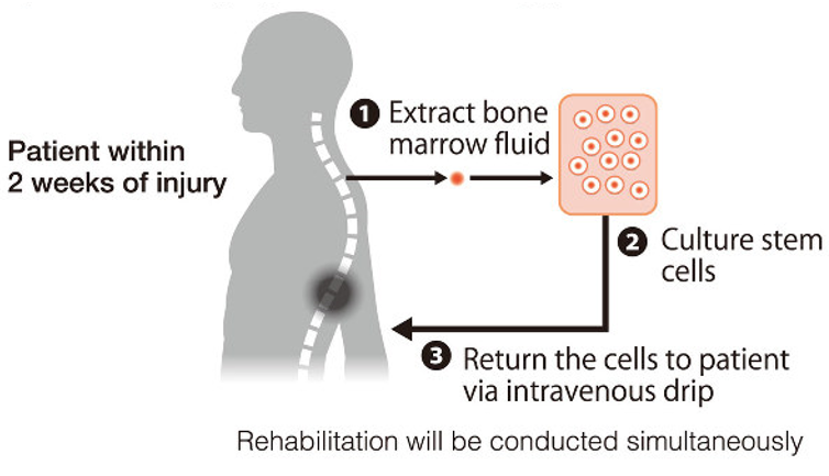 新型设计可注射高分子水凝胶材料用于防止脊髓损伤治疗过程中移植的施旺细胞流失