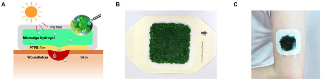 糖尿病患者的福音：南京大学开发出治疗慢性伤口的微藻凝胶贴片